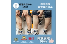香港炎症中心_真實客戶分享_濕疹治療6